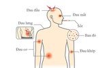 [ẢNH] Những loại bệnh dịch phổ biến do thời tiết ở Việt Nam